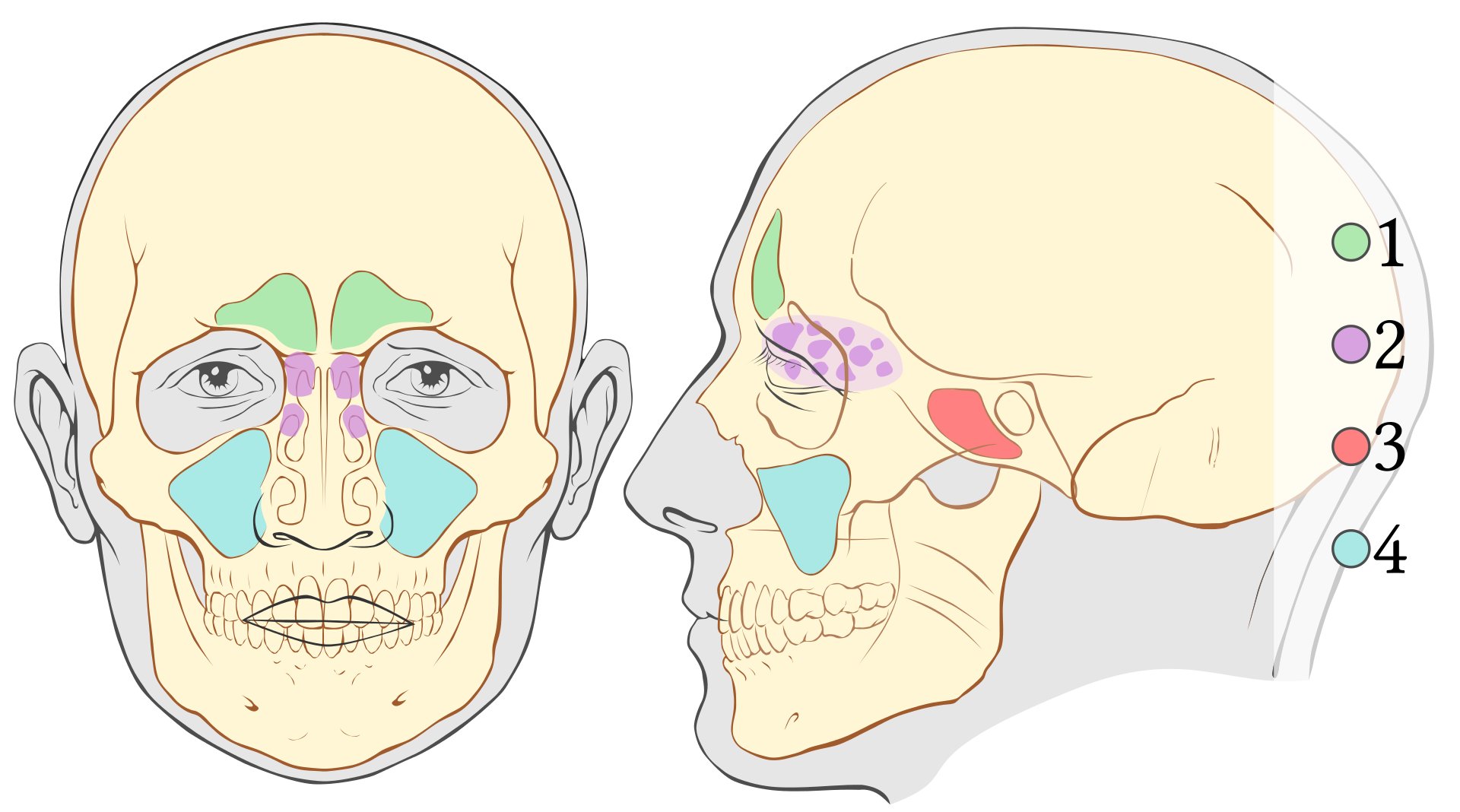 Définition : qu'est-ce qu'une sinusite maxillaire ?