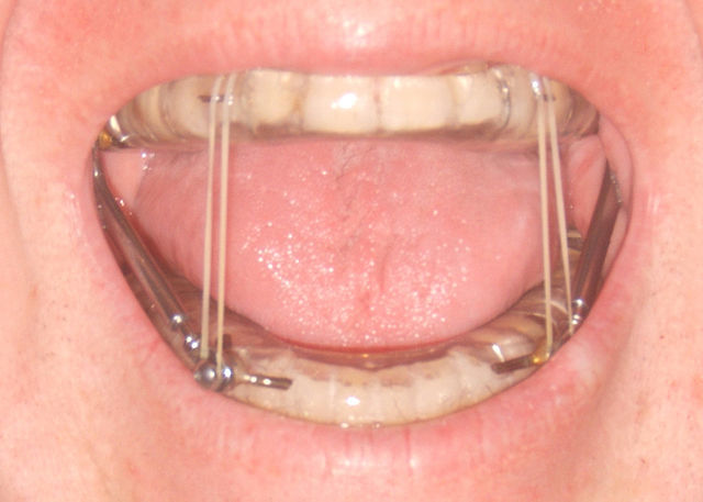 Traitement par orthèse d'avancée mandibulaire ou gouttières anti-ronflements