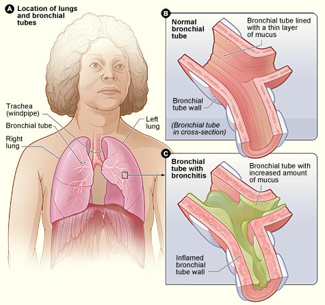 Définition : qu'est-ce qu'une bronchite aiguë? 