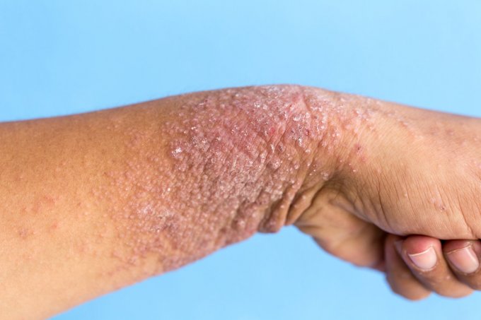 Protection pour incontinence : elle peut favoriser les dermatites