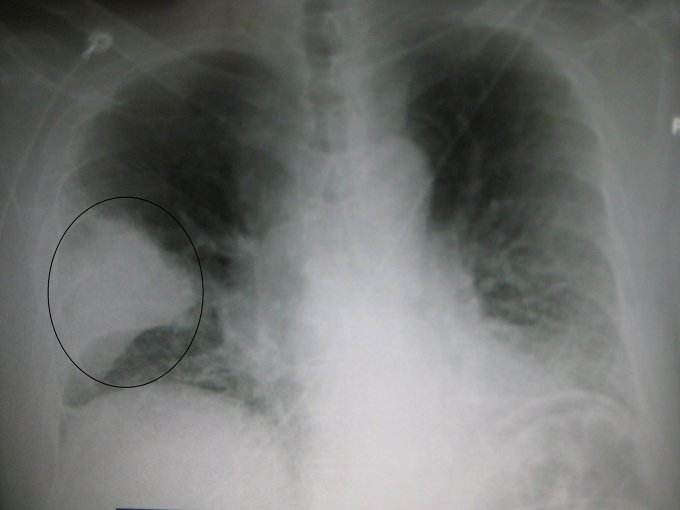 Photo : cette radiographie du thorax montre une pneumonie aiguë dans le poumon droit