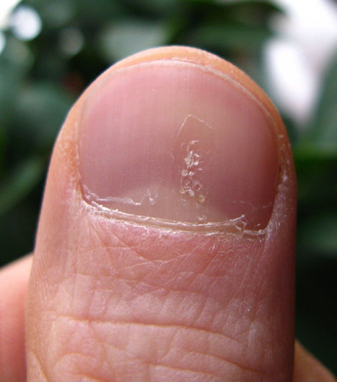 Photo : psoriasis des ongles en dé à coudre