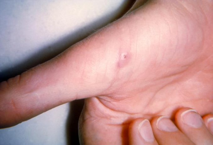 Photo : une lésion sur la main d&apos;une personne atteinte de la maladie des griffes du chat