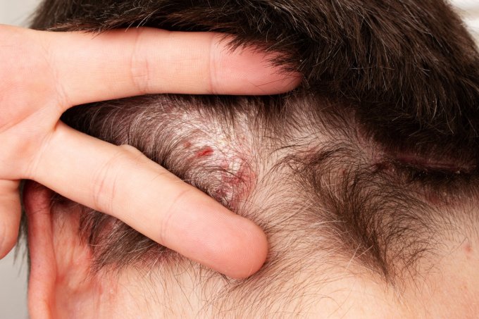 Symptômes : comment reconnaître un psoriasis du cuir chevelu ?