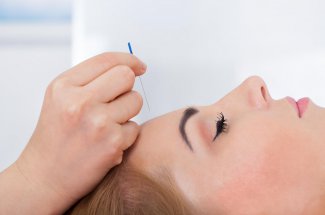Cephalees : l-acupuncture, traitement miracle contre les maux de tete ? 
