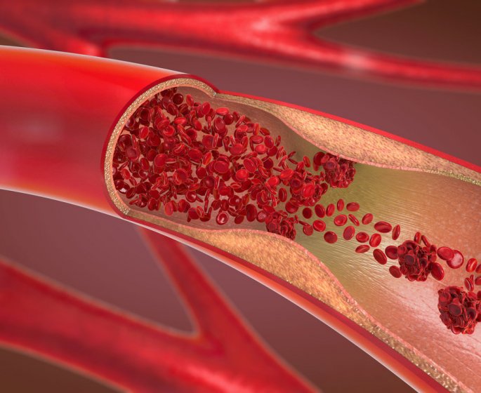 Phlebite ou thrombose veineuse (mollet, jambe...) : symptomes et traitements