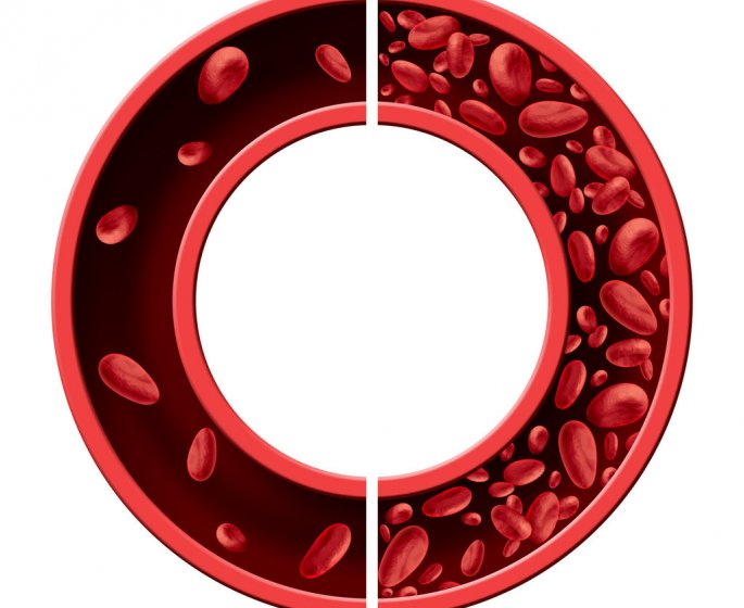 Anemie : symptomes, causes, traitements, risques et complications