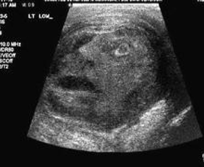 Un visage humain decouvert sur la radiographie d-un testicule