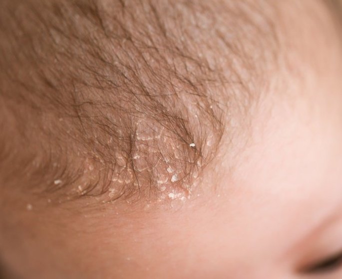 Dermatite seborrheique : comment enlever les croutes de lait de bebe ?
