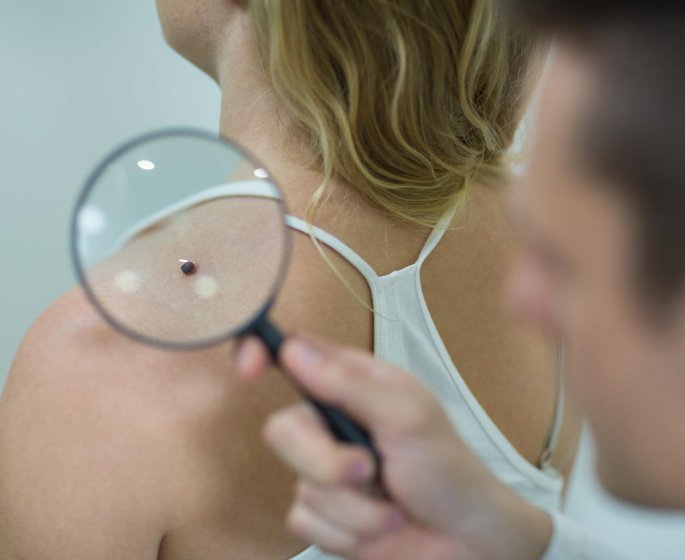 Tache sur la peau : detecter un cancer de la peau