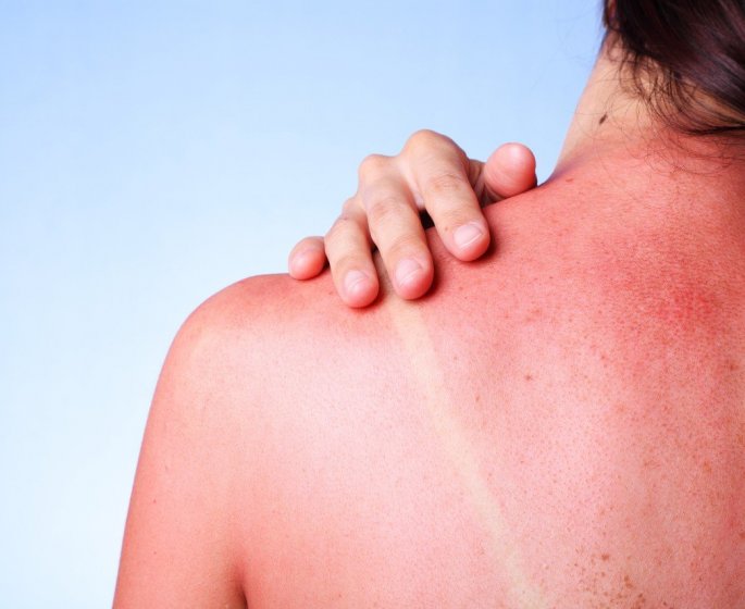 Coup de soleil : une femme devoile une effrayante cloque apres avoir bronze sans creme