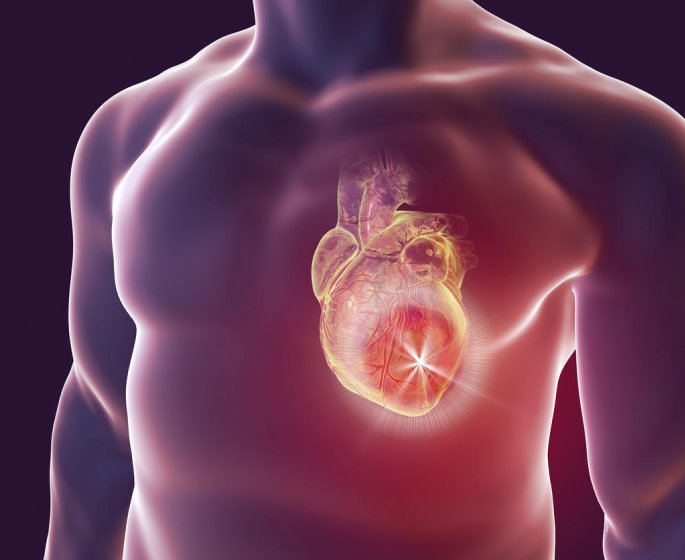 Infarctus du myocarde (crise cardiaque) : symptomes, causes, traitements 