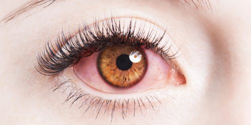 Oeil irrite et gonfle : les symptomes d-une maladie ?