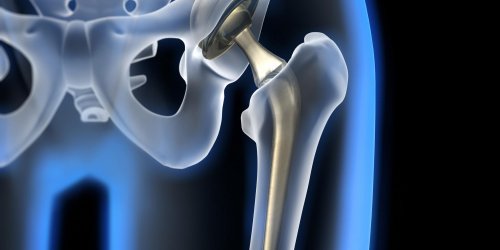 Coxarthrose, arthrose de la hanche : quels symptomes et traitements pour la soigner ?