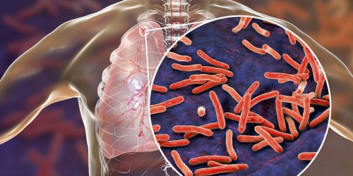 Tuberculose : les signes a reperer