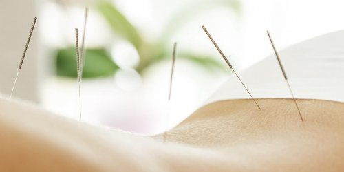 Acupuncture : une solution pour maigrir vite ?