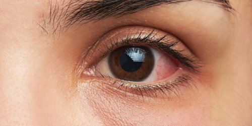 Yeux rouges : les causes de l-irritation de l-oeil