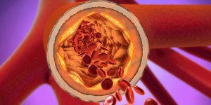 Facteurs de risque cardiovasculaire : le role du cholesterol LDL