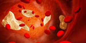 Cholesterol HDL bas : misez sur les phytosterols