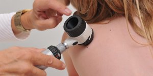 Granulome pyogenique : un risque de cancer de la peau ?