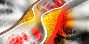 Statines : 3 effets secondaires des medicaments contre le cholesterol