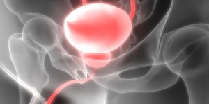 Les aliments qui augmentent le risque d’un cancer de la prostate avance