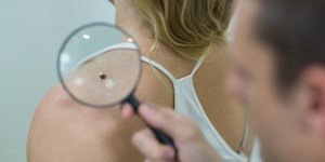Tache sur la peau : detecter un cancer de la peau