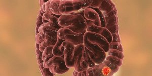 Pourquoi le surpoids augmente le risque de cancer du colon