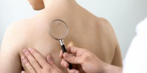 Cancer de la peau : avoir eu plus de 10 partenaires sexuels augmente vos risques !