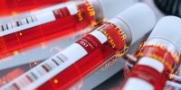 Coronavirus : qu'est-ce qu'un test sérologique ?